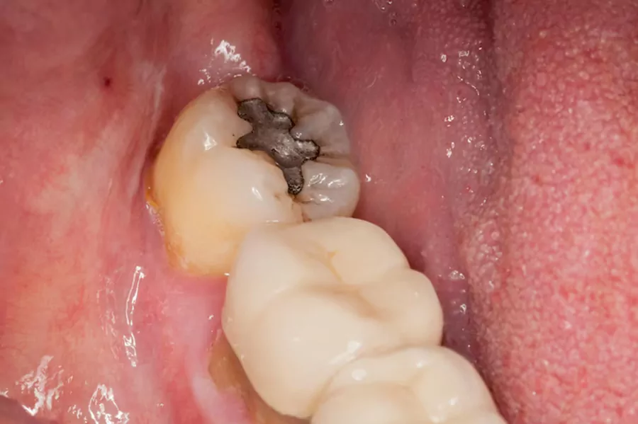 عصب کشی کردن دندان