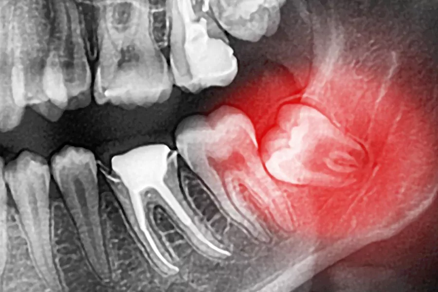 درد کشیدن دندان عقل تا چه زمانی ادامه خواهد داشت؟