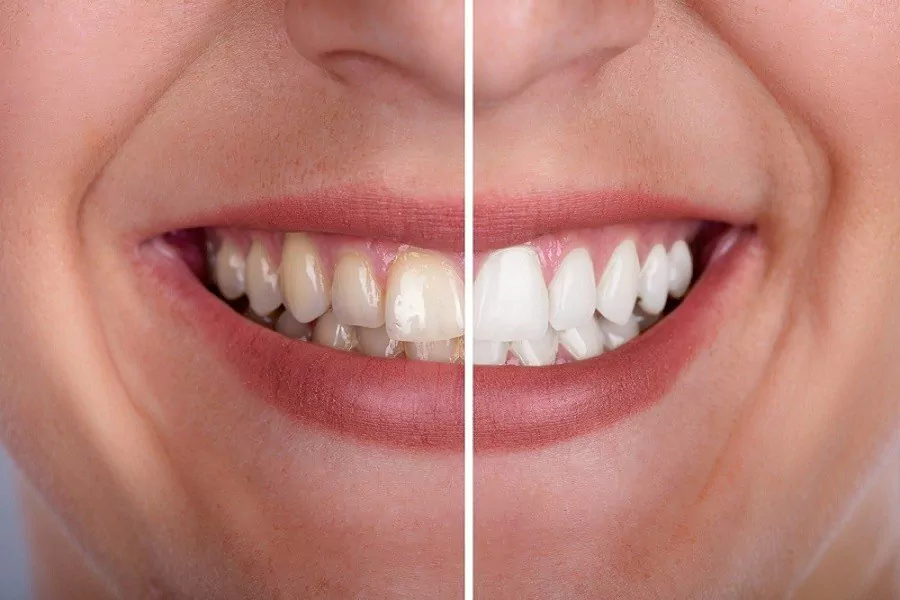 جراحی زیبایی دندان