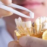 ایمپلنت دندان برای چه کسانی مناسب است؟