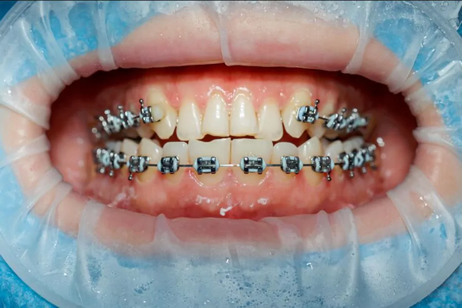 ارتودنسی دندان برای چه کسانی مناسب است؟