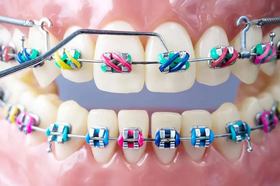 بهترین نوع ارتودنسی دندان کدام است؟