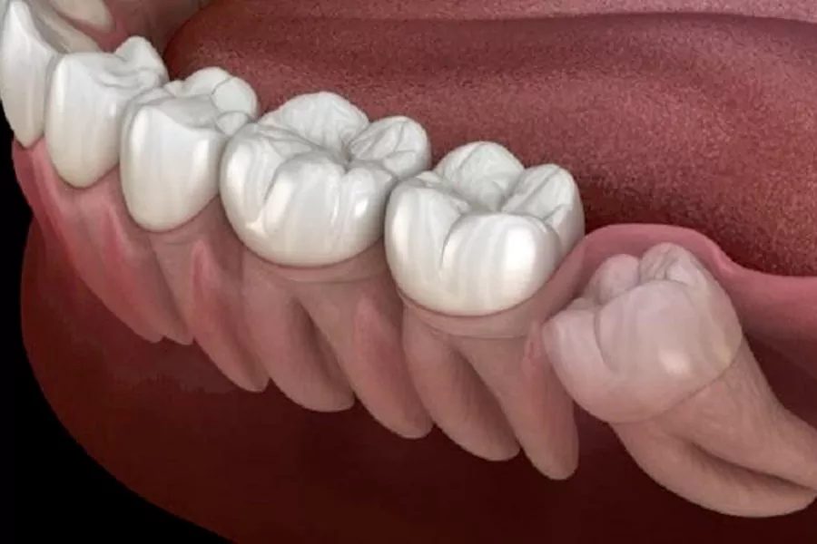 دندان عقل چیست و کجا قرار گرفته است؟