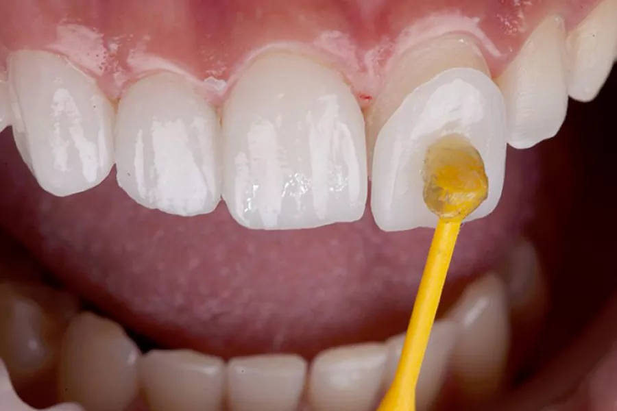 مزایا و معایب لیمنت دندان