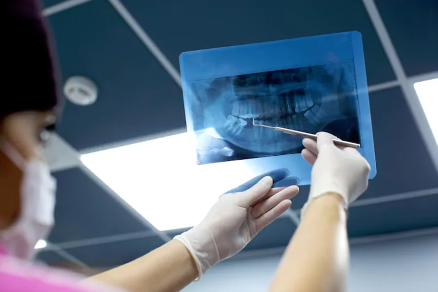 تاثیر پوکی استخوان در ایمپلنت دندان