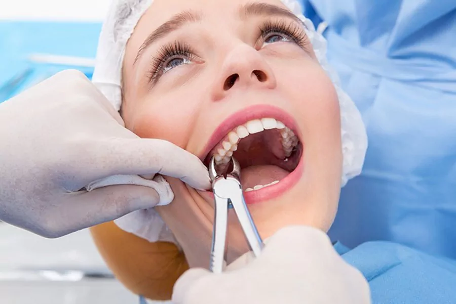به چه علت دندان عقل باید کشیده شود؟