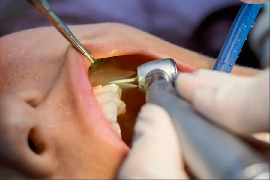 عصب کشی دندان (روت کانال تراپی)
