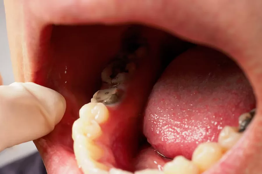 مزایای عصب کشی دندان