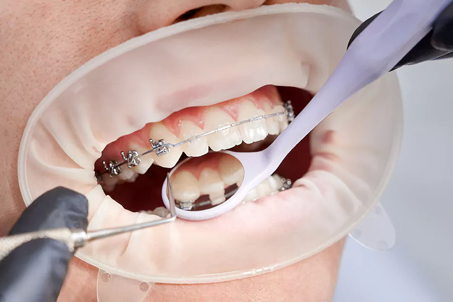 انواع روش ارتودنسی دندان