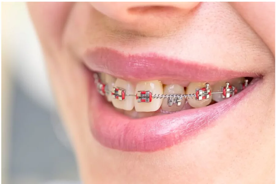 ارتودنسی دندان نیش چگونه است؟