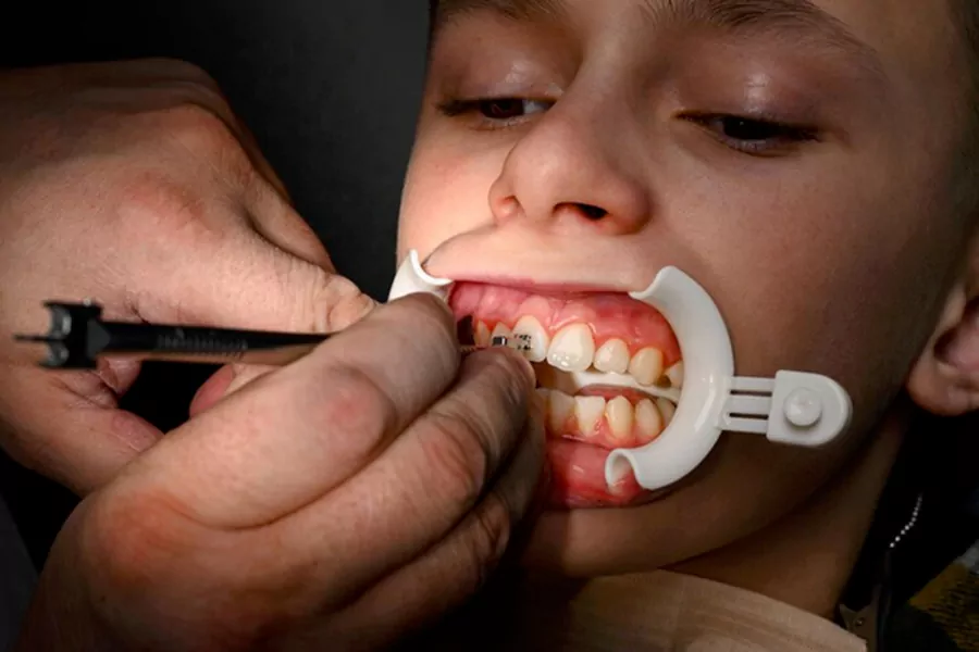 مدت زمان ارتودنسی دندان چقدر است؟
