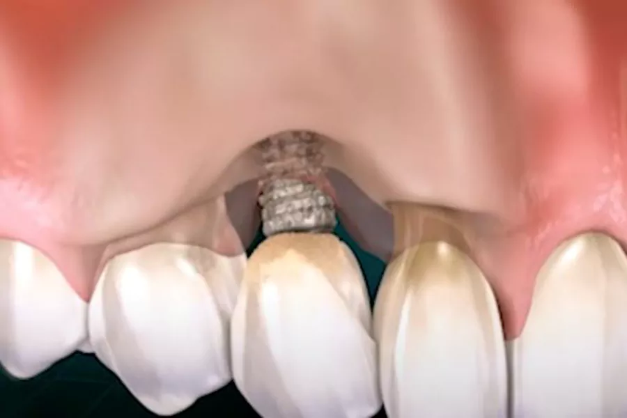 خطرات و عوارض ایمپلنت دندان