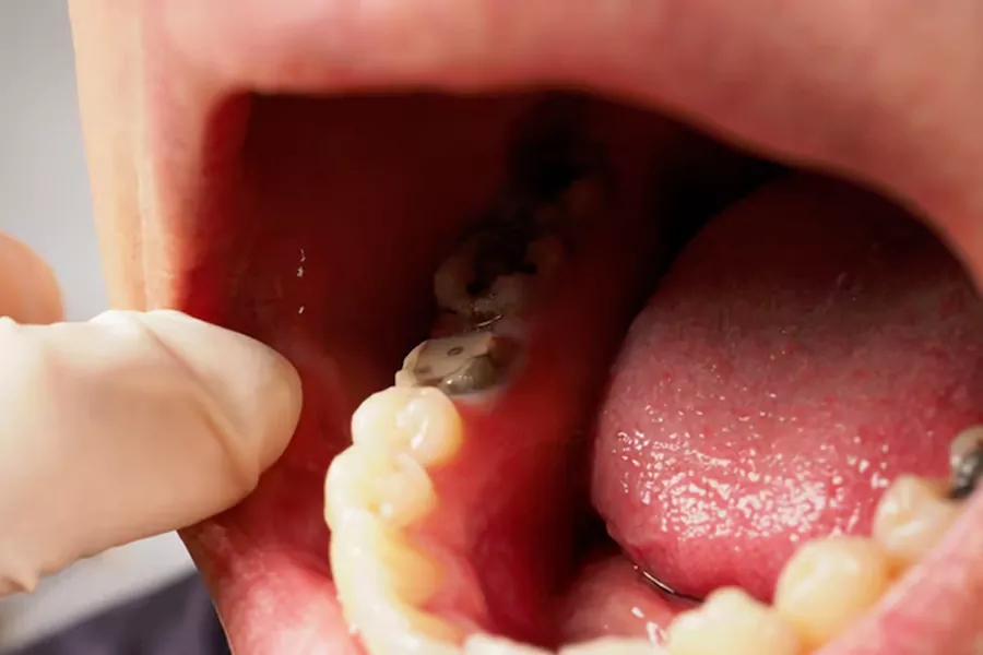 علائم عفونت پالپ دندان