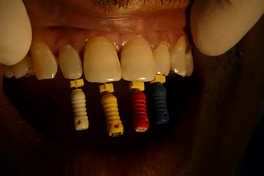 مراحل عصب ‌کشی دندان