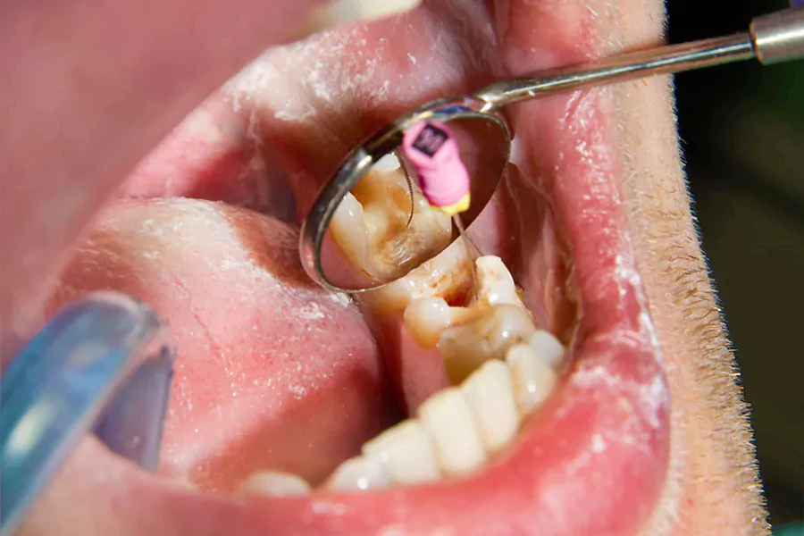 درمان مجدد دندان