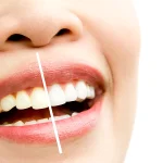 کاربرد کامپوزیت دندان