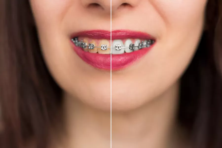 معایب کامپوزیت دندان کدامند؟