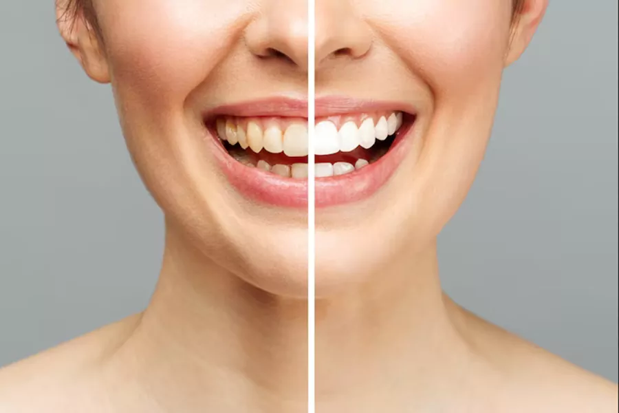 کاربرد کامپوزیت دندان