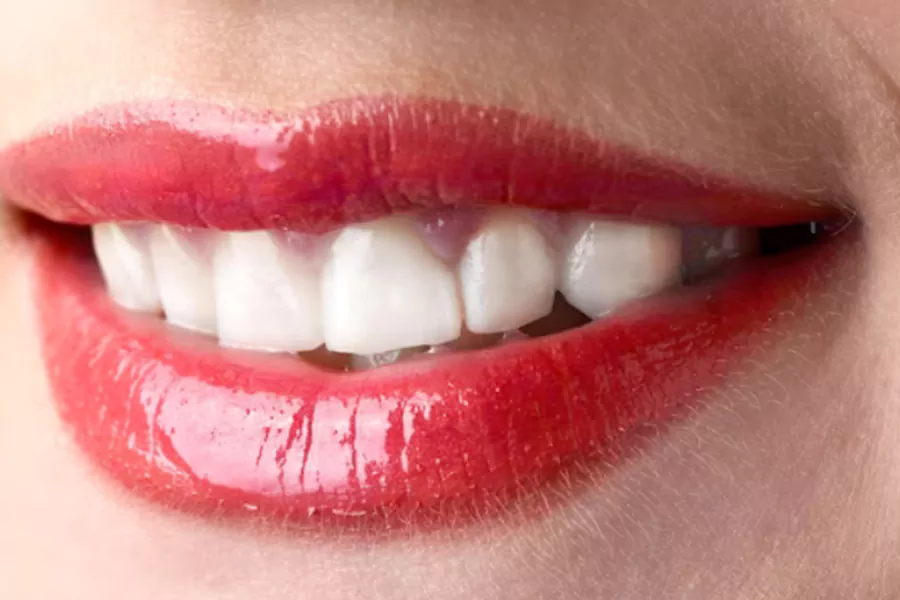 انواع روش‌ های کامپوزیت دندان