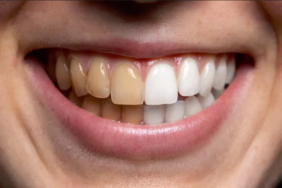 کامپوزیت دندان برای چه کسانی مناسب است؟