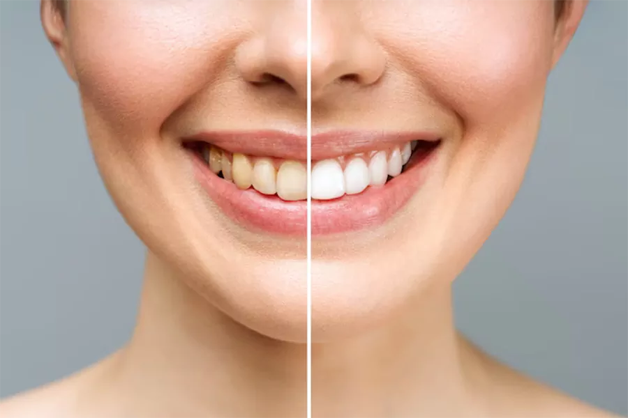 عوامل موثر بر کاهش طول عمر لمینت دندان