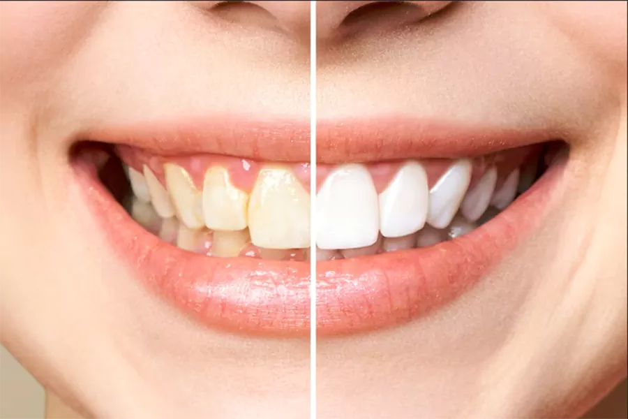 آیا امکان تغییر رنگ کامپوزیت دندان وجود دارد؟