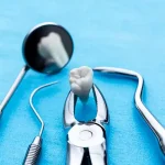 انواع جراحی دندان عقل