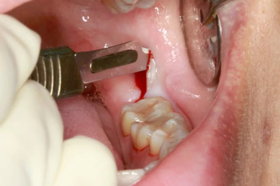 مزایای جراحی دندان عقل نهفته و نیمه نهفته