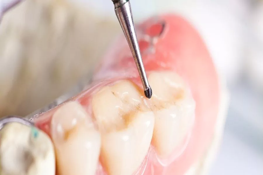 آیا امکان پر کردن دندان بدون عصب کشی وجود دارد؟