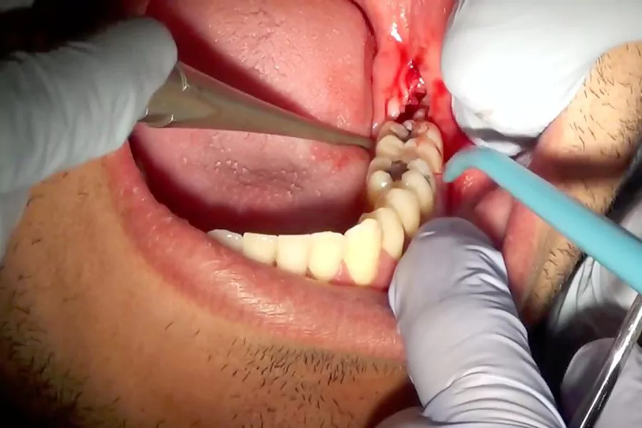 انواع مختلف جراحی دندان عقل