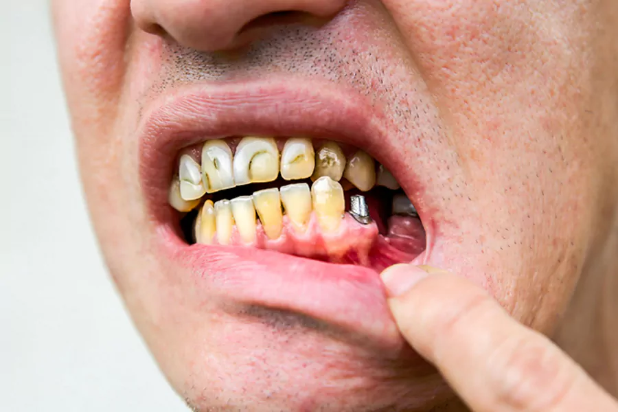 عوارض طبیعی ایمپلنت دندان