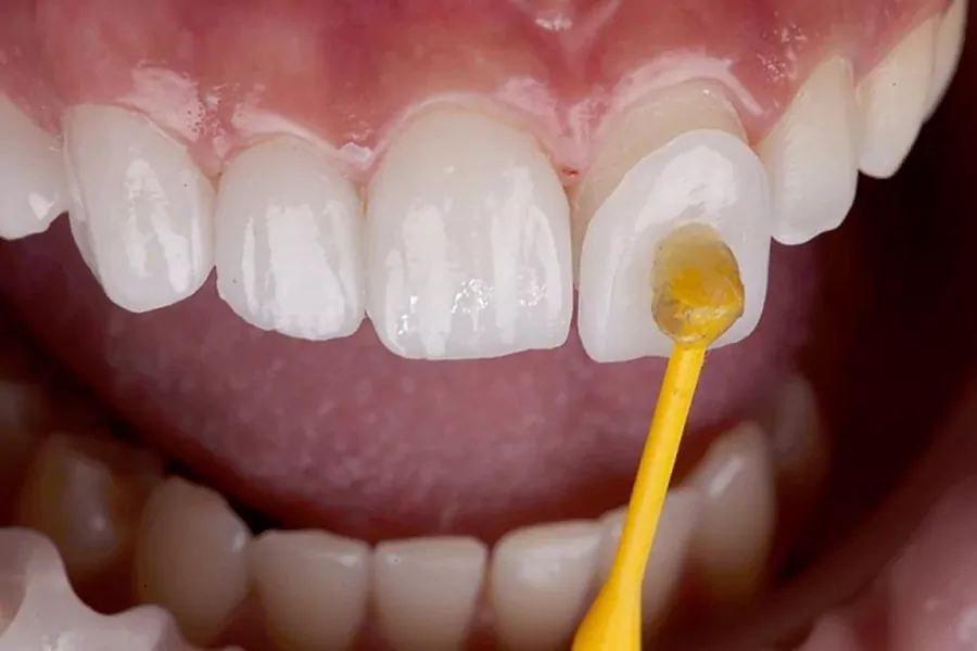 آیا برای نصب لومینیرز دندان ها تراش داده می شوند؟