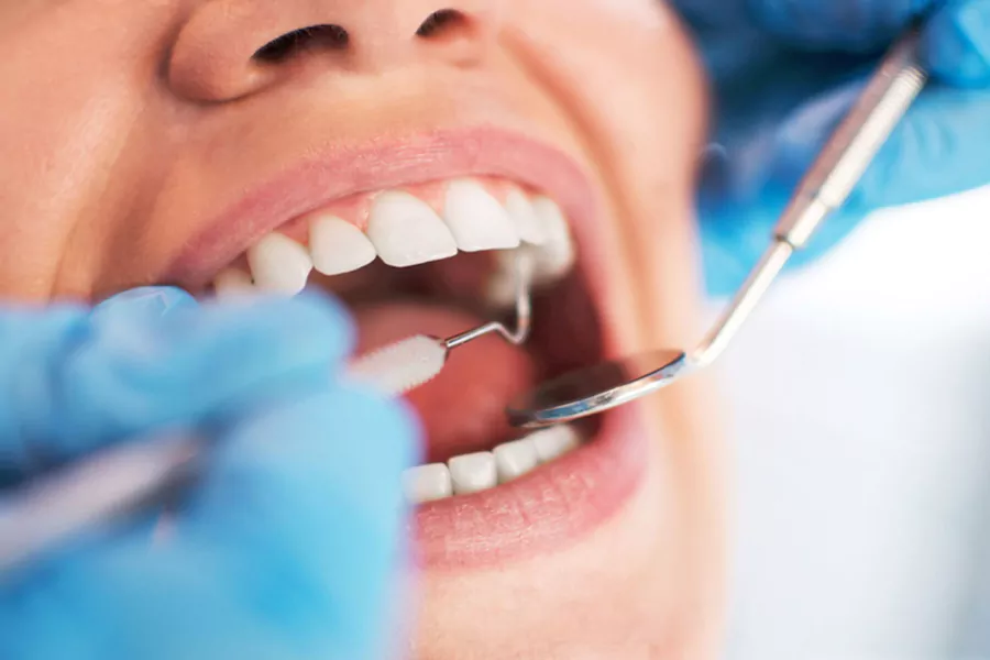 مراحل اتصال باندینگ به دندان
