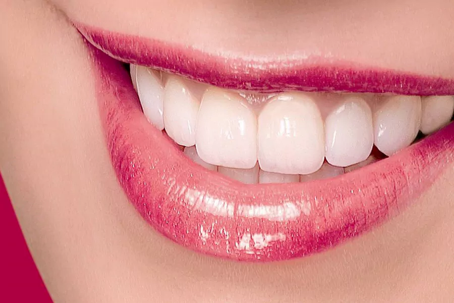 هزینه لومینیرز دندان چقدر است؟