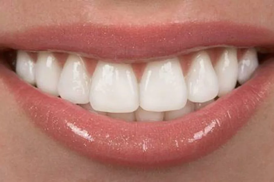 کاربردهای لومینیرز دندان کدام هستند؟