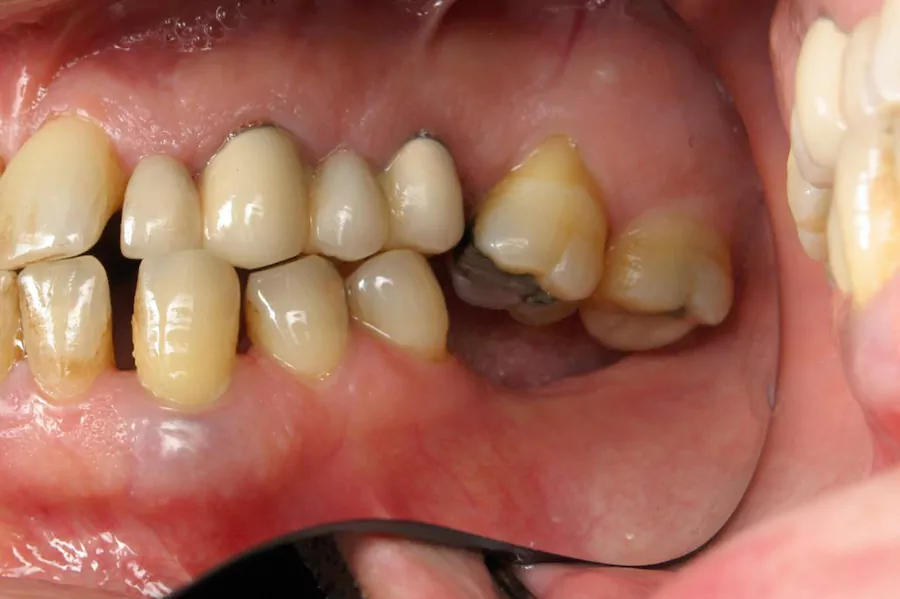 دندان عقل و انواع آن