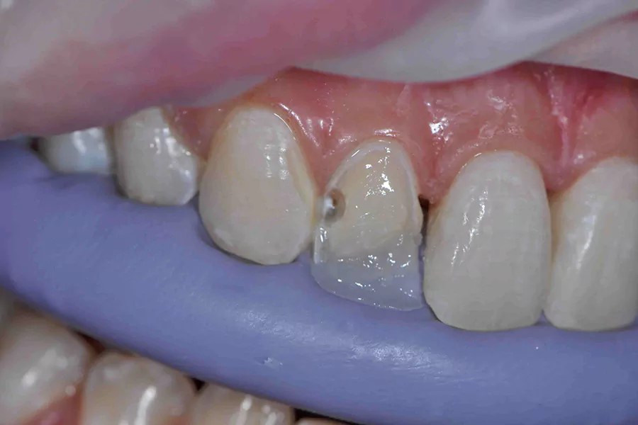نوع و چگونگی اتصال مواد کامپوزیت بر روی دندان‌ها