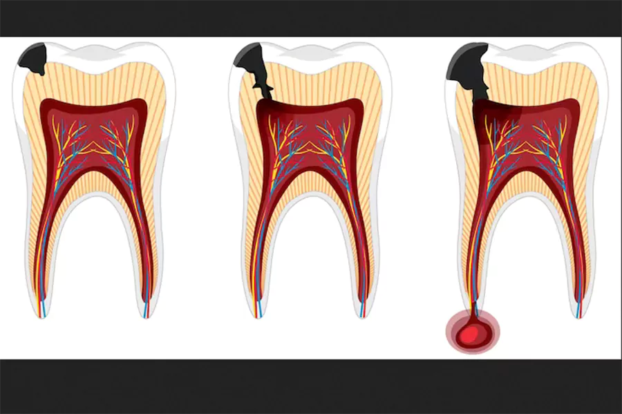 بروز درد پس از عصب کشی دندان نشانه چیست؟