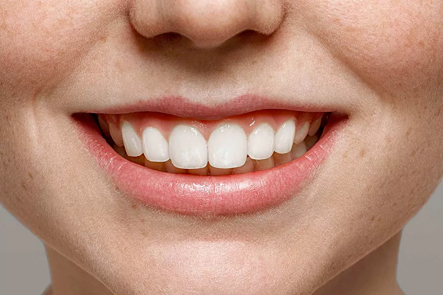 هزینه باندینگ دندان چقدر است؟