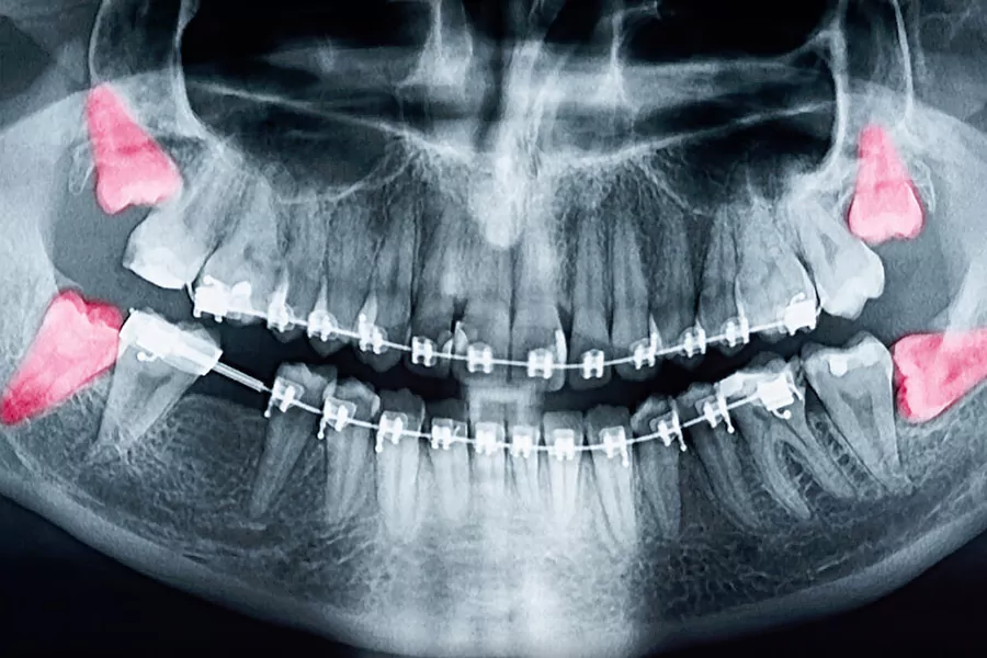 جراحی دندان عقل چقدر هزینه دارد؟