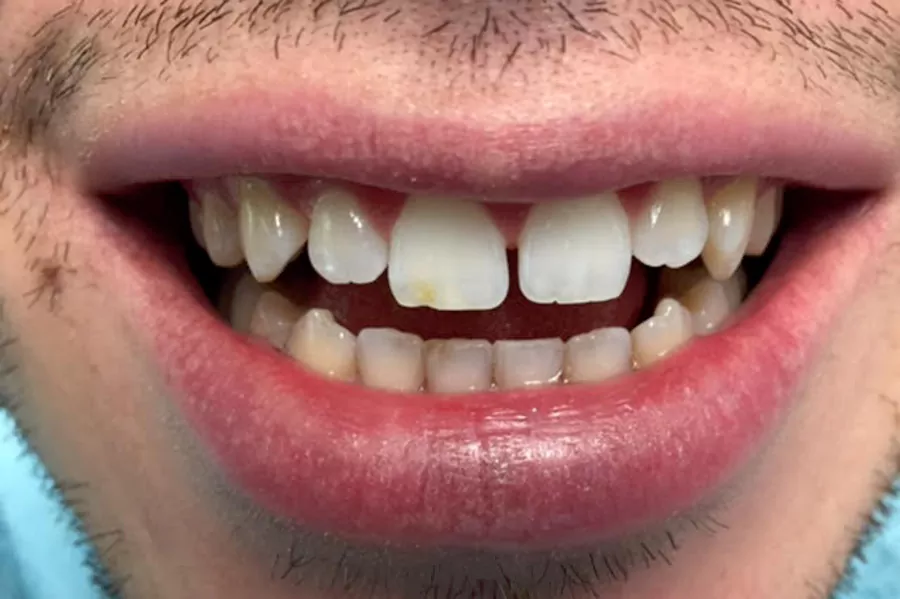 باندینگ درمان؛ راهی برای ترمیم دندان ها