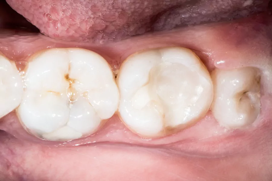 عوارض پس از جراحی دندان عقل