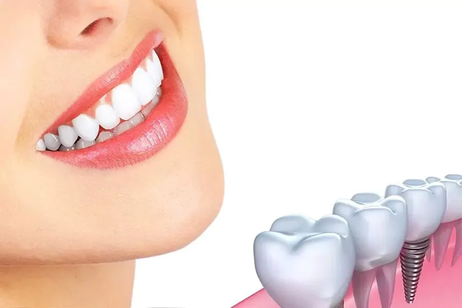 فاکتورهای مهم در قیمت ایمپلنت دندان کدامند؟