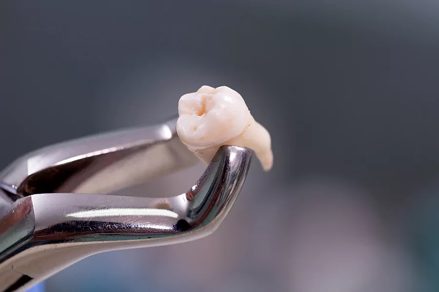 بهبودی دندان عقل پس از جراحی