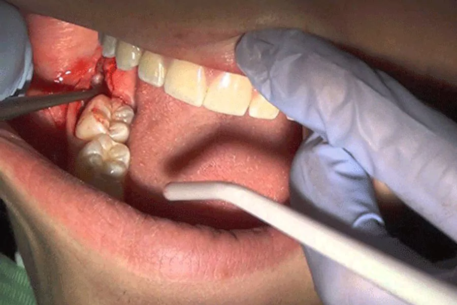 چه زمانی کشیدن دندان عقل الزامی است؟