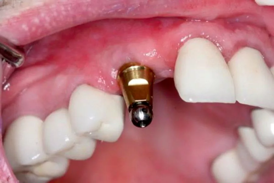 مهم ترین مزایای ایمپلنت دندان
