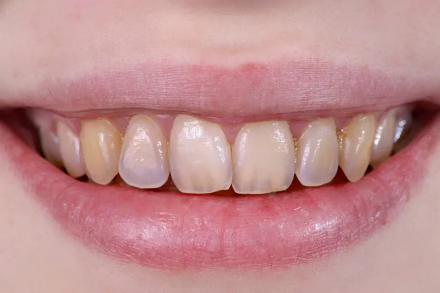 لمینت دندان چه معایبی دارد؟