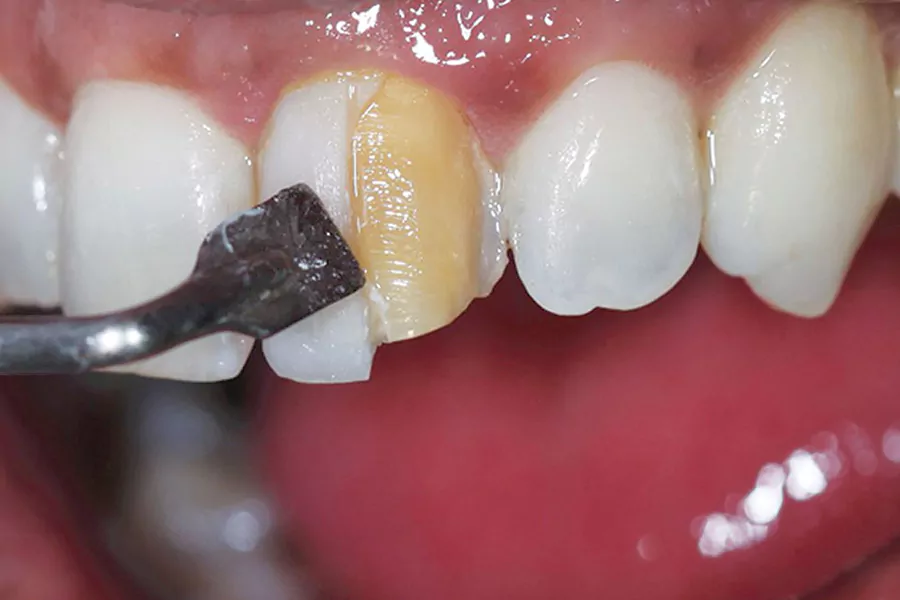 کامپوزیت برای دندان‌های کج، فاصله‌دار و دندان‌های جلو
