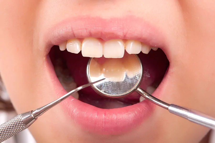 هزینه کامپوزیت دندان جلو چقدر است؟