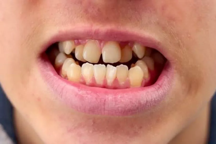 ارتودنسی دندان چه مزایایی دارد؟
